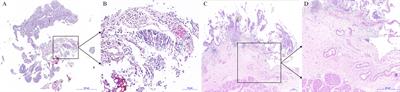 En Bloc Tumor Resection, Optical Molecular Imaging, and the Potential Synergy of the Combination of the Two Techniques in Bladder Cancer